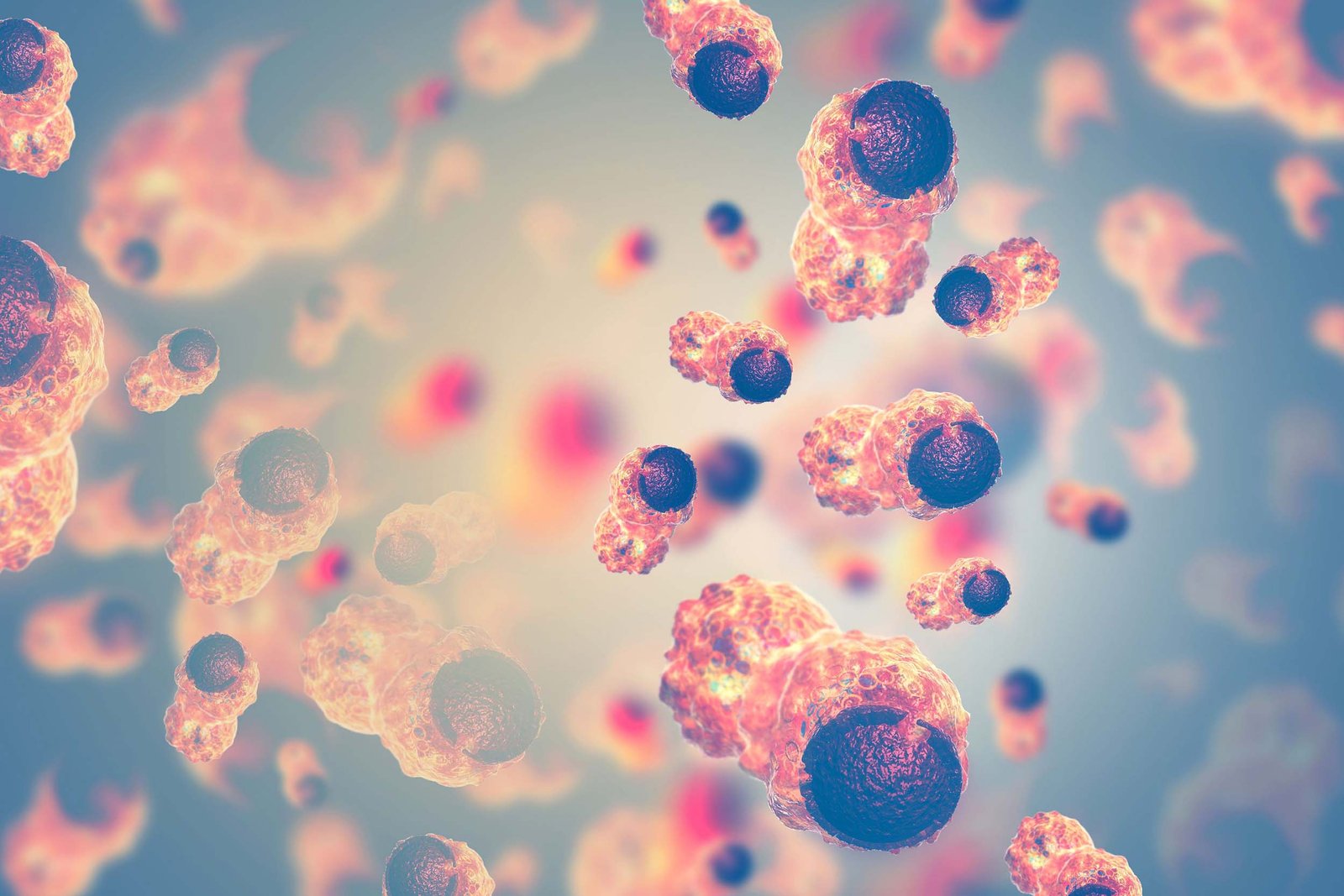 Imagen microscópica colorida que muestra células cancerosas de forma irregular, dividiéndose rápidamente con núcleos agrandados, invadiendo agresivamente y desplazando tejido sano circundante.