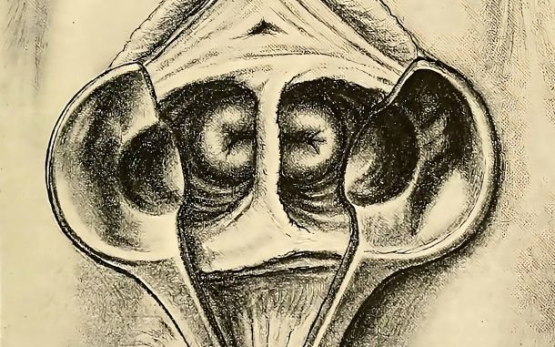 Understanding Uterus Didelphys and Embracing Self-Acceptance